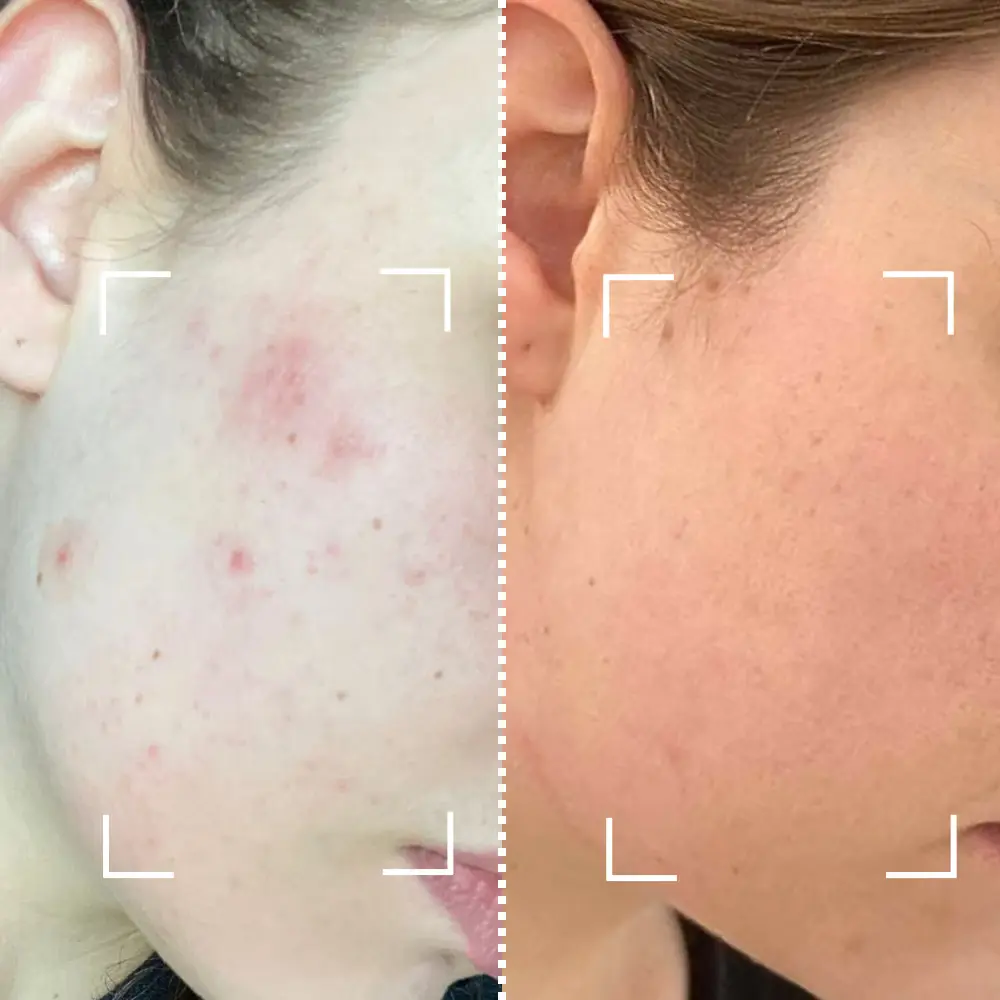 Masque LED visage avant après : résultats réels, délais et analyse des photos 6 avant apres masque led acne personne 1