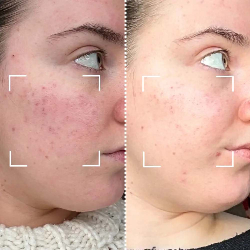 Masque LED visage avant après : résultats réels, délais et analyse des photos 7 avant apres masque led acne personne 2