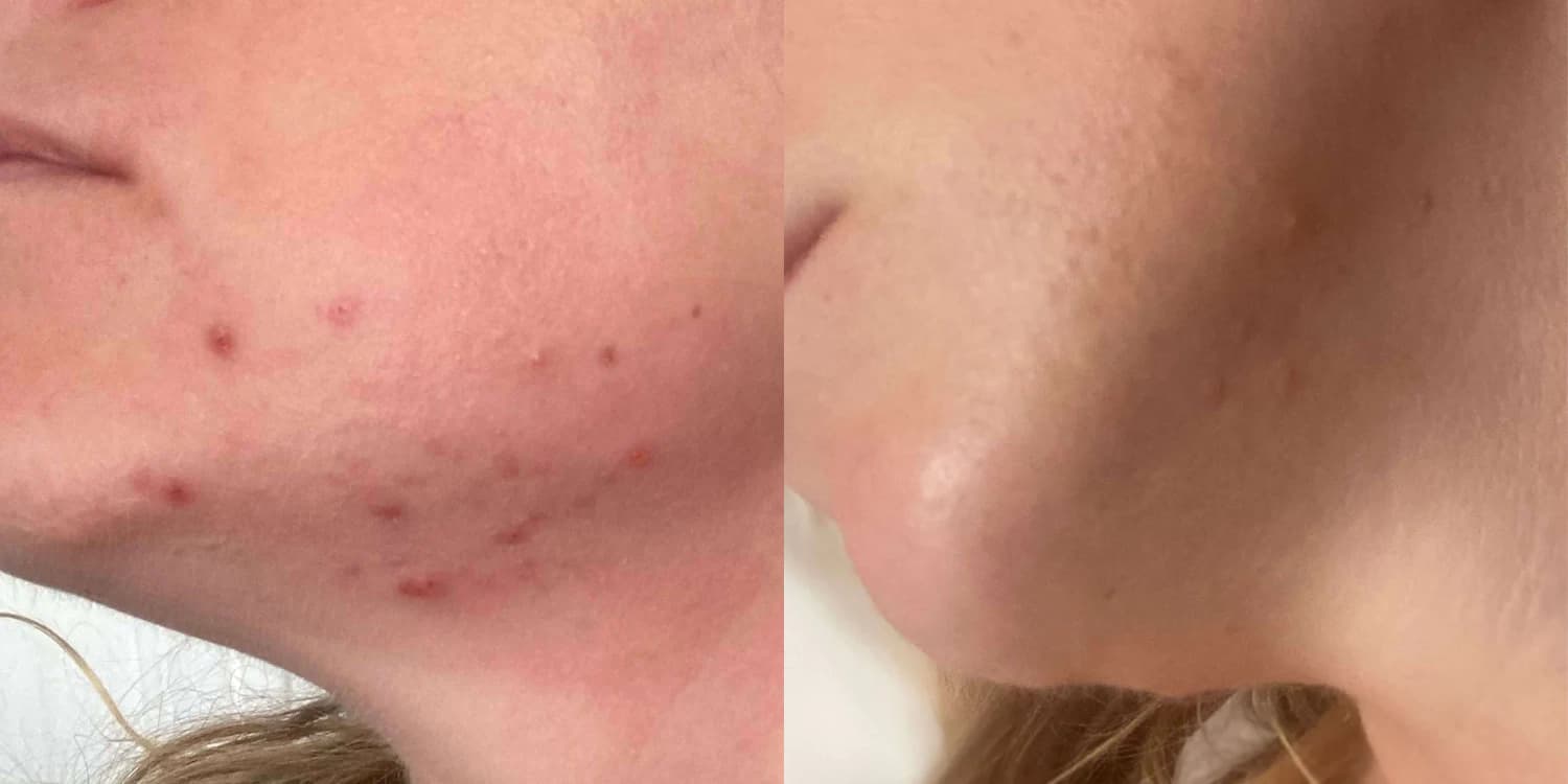 Mon avis sur Skin and Out Analyse et test complet des cosmétiques et compléments 21 avant apres alice skin and out 1