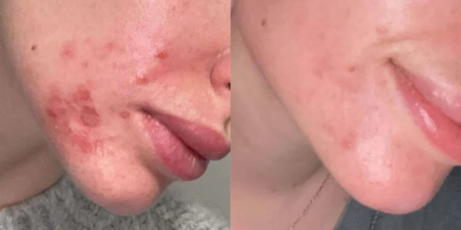 Mon avis sur Skin and Out Analyse et test complet des cosmétiques et compléments 20 avant apres josephine skinandout 1