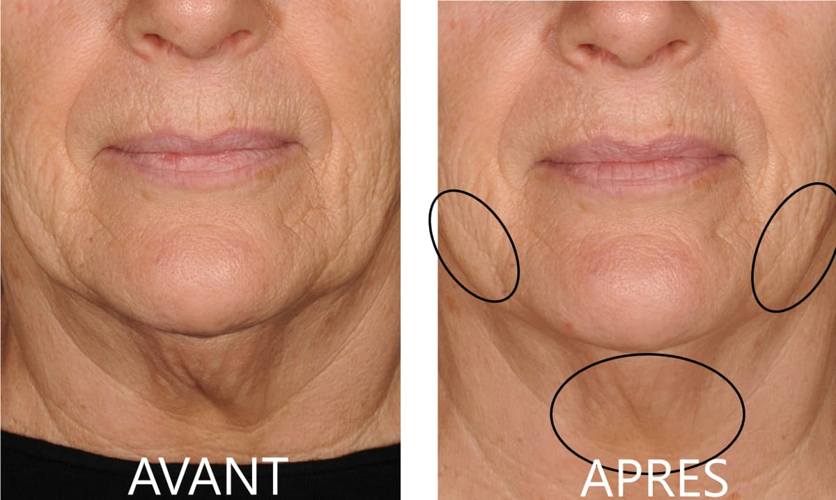 LightInDerm : Mon avis avec test de leur appareil anti-âge complété par une revue d'avis clients 8 avant apres lightinderm preuve efficacite cliente