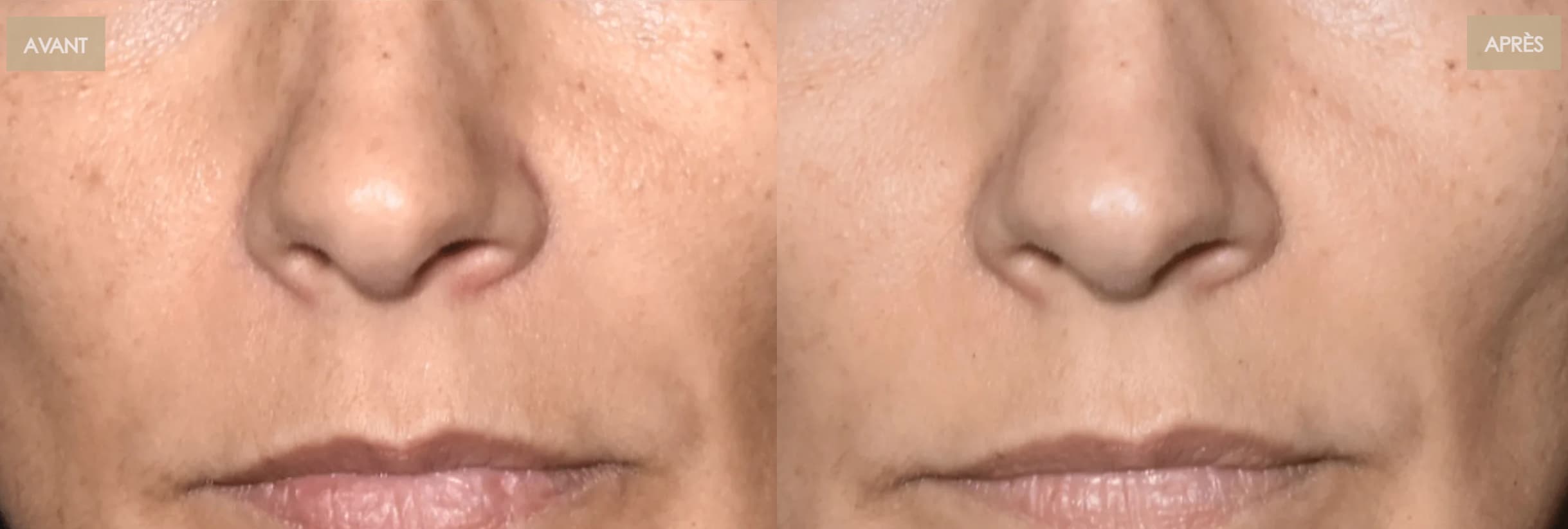 Avis sur Nooance : J'ai testé leur masque à led et je donne mon avis personnel 10 avant apres amelioration teint