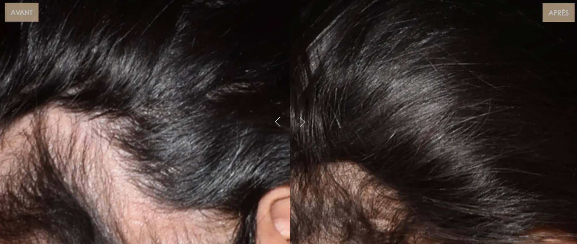 Casque LED cheveux : guide complet pour lutter contre la chute et permettre la repousse 7 avant apres brillance