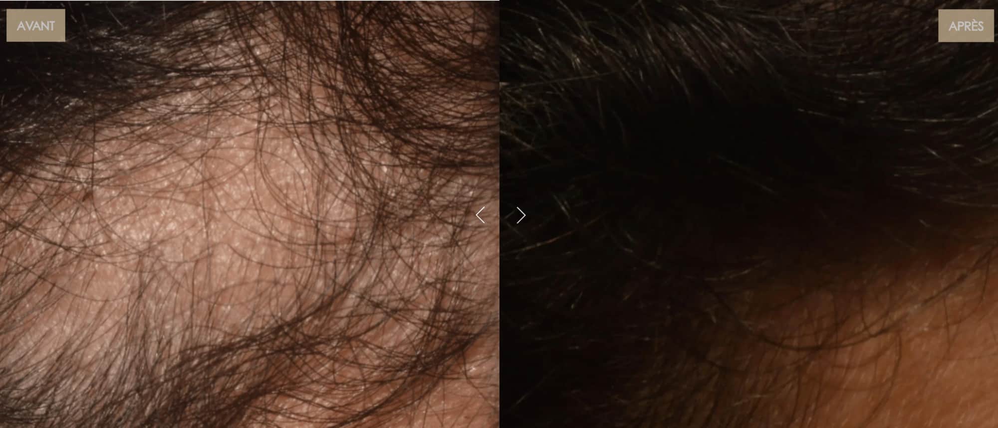 Le casque LED cheveux de Nooance : Mon Avis complet avec test personnel et revue des études 12 avant apres casque chute cheveux 1