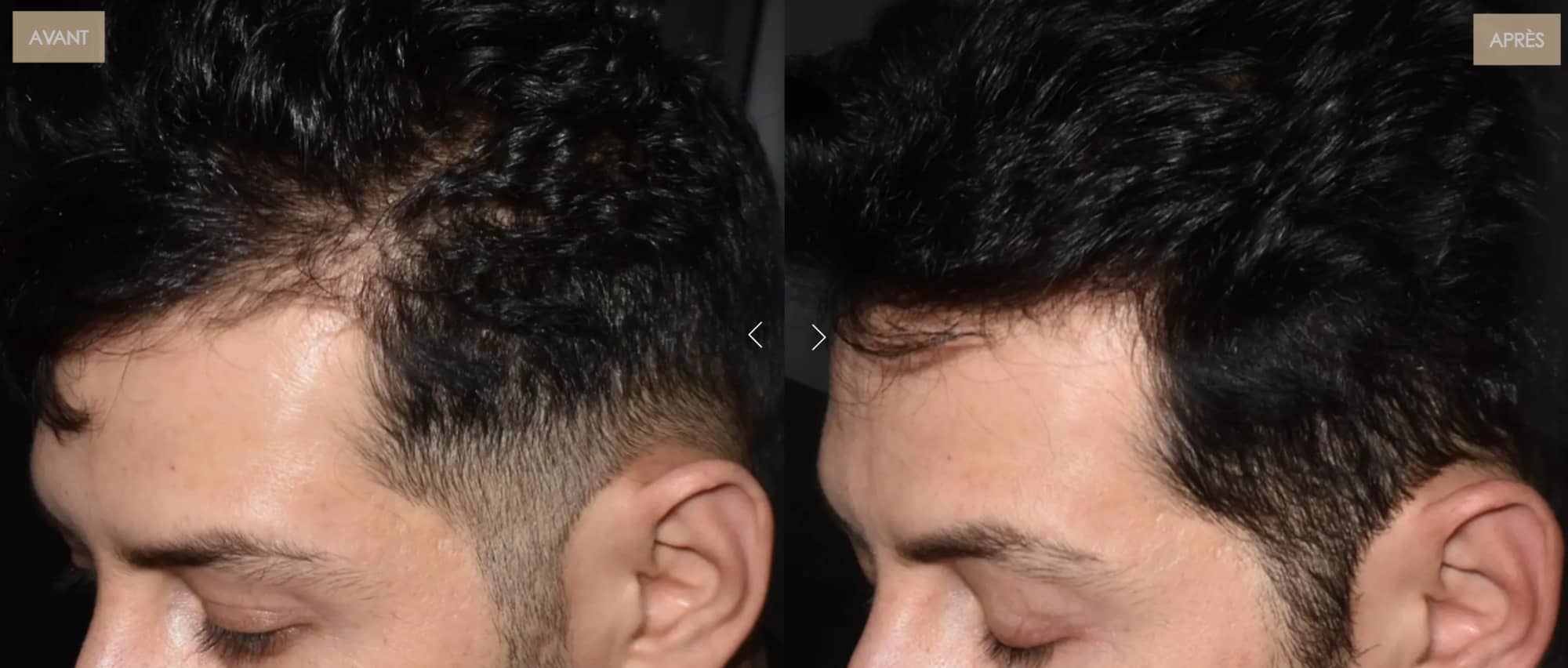 Le casque LED cheveux de Nooance : Mon Avis complet avec test personnel et revue des études 9 avant apres densite capillaire 1