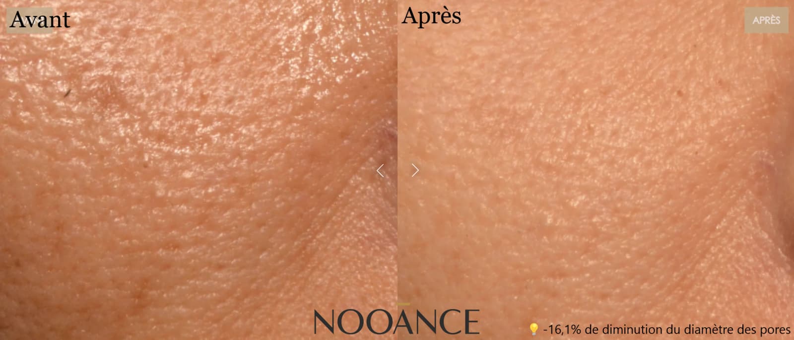 Avis sur Nooance : J'ai testé leur masque à led et je donne mon avis personnel 9 avant apres diametre pore peau masque nooance 1