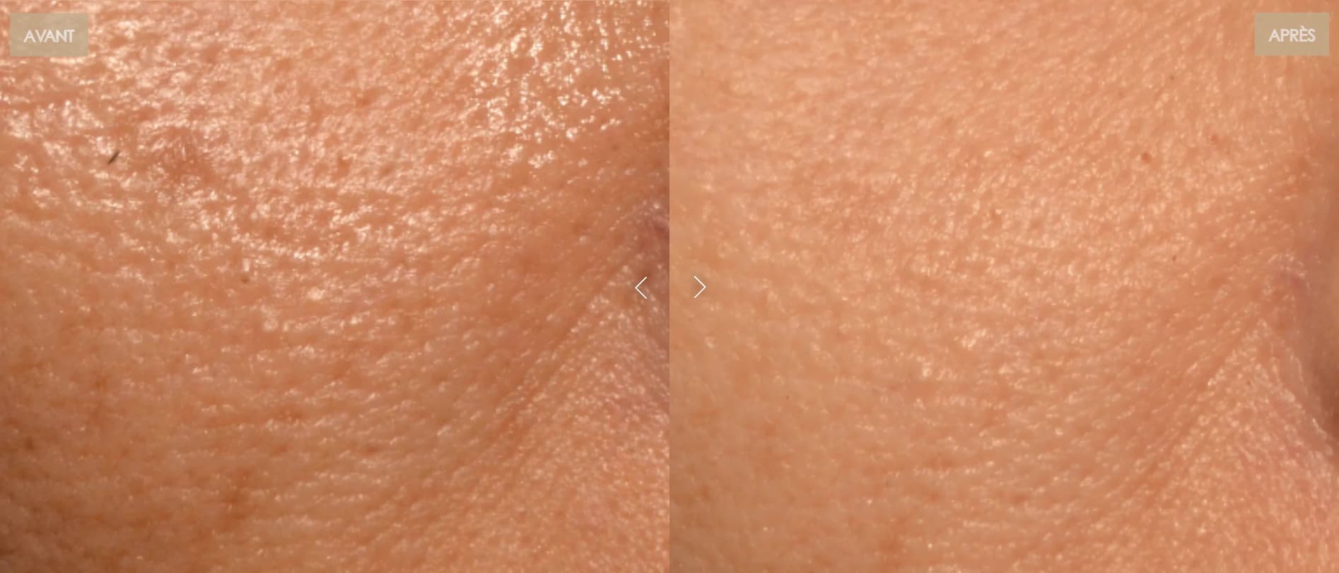 Comparatif des masques LED Quel est le meilleur masque : prix, qualité, irradiance… 15 avant apres diminution pores nooance 1