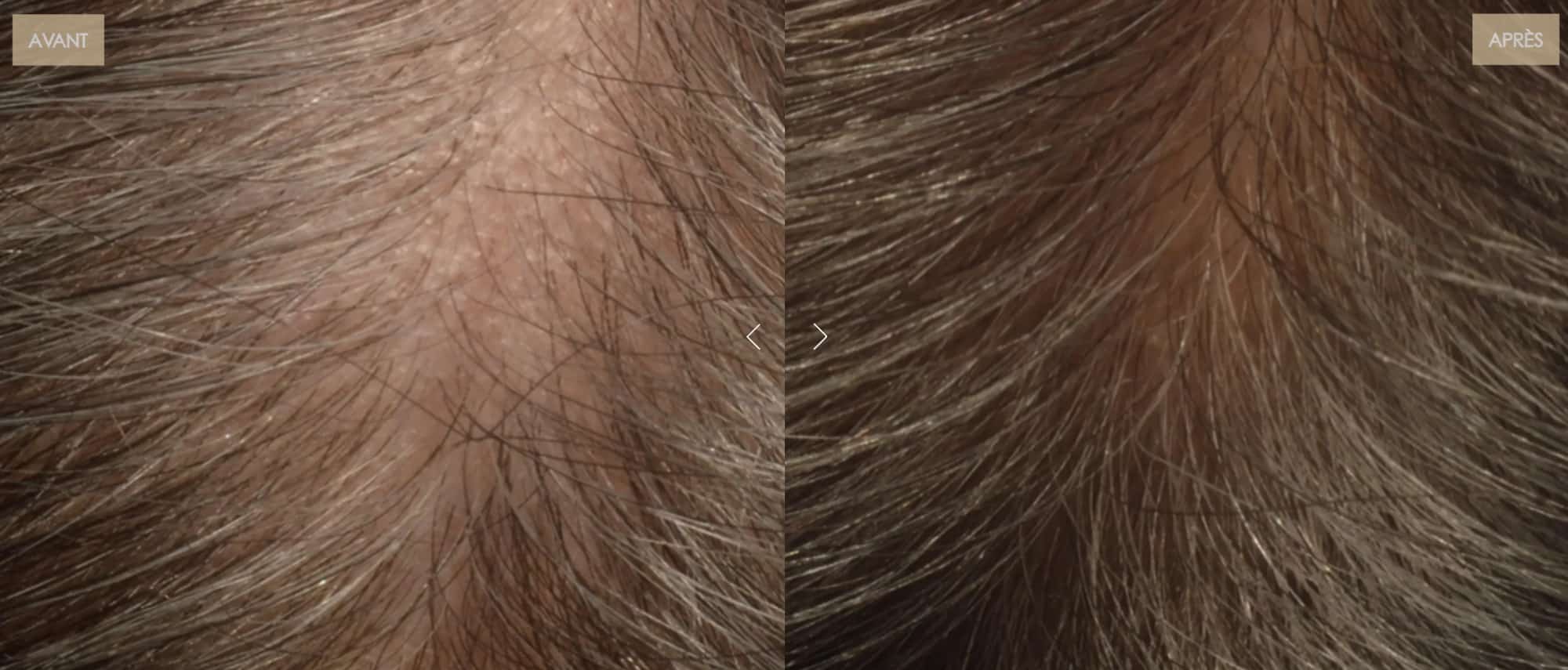 Le casque LED cheveux de Nooance : Mon Avis complet avec test personnel et revue des études 11 avant apres epaisseur 1