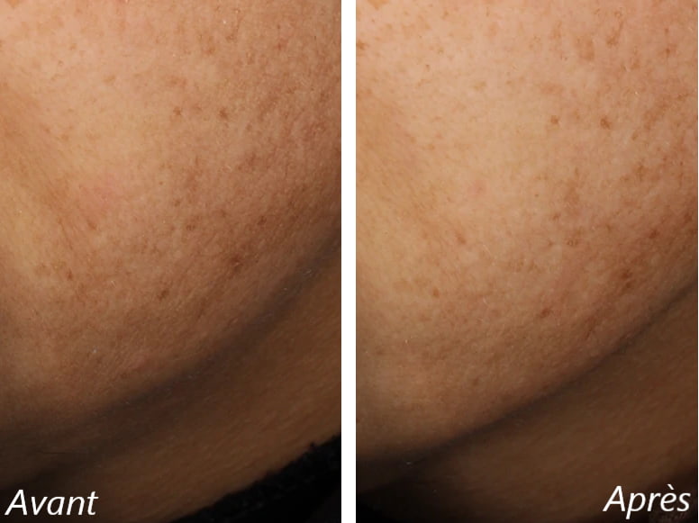 Avis sur Foreo : Mon test personnel de leur appareil Bear 2 7 avant apres foreo 1