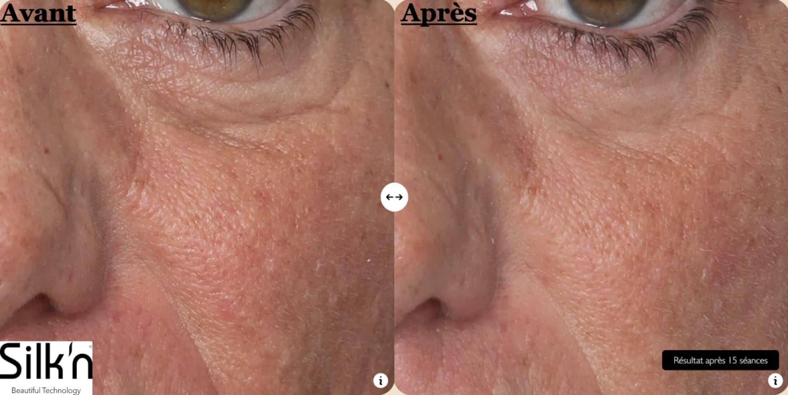 Les avant après des meilleurs masques à LED pour visage : lequel est le plus convaincant ? 7 avant apres masque led silkn 1