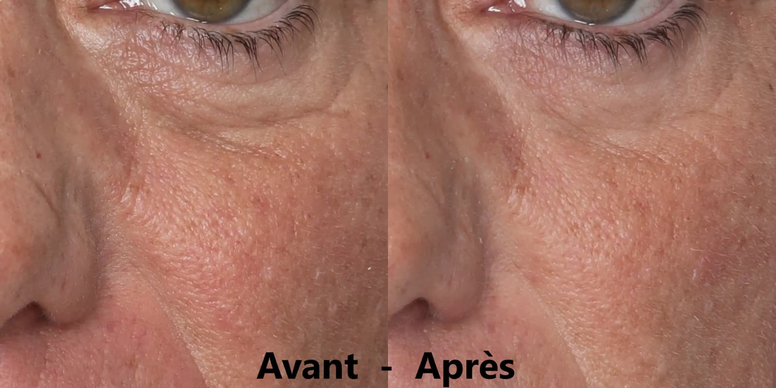 Mon avis sur le masque Silk'n Analyse complète avec résultats et comparatif 6 avant apres masque silkn cernes 1