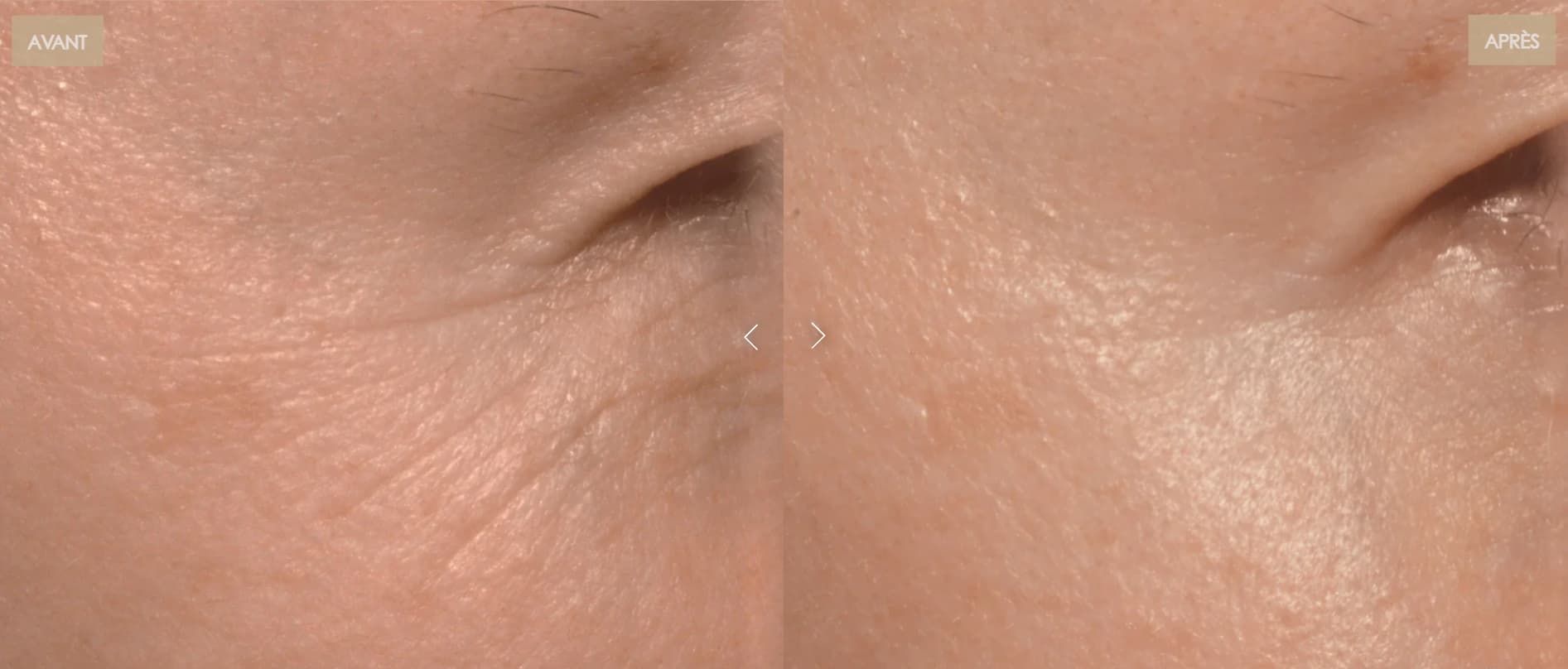 Comparatif des masques LED Quel est le meilleur masque : prix, qualité, irradiance… 14 avant apres pattes oies 1