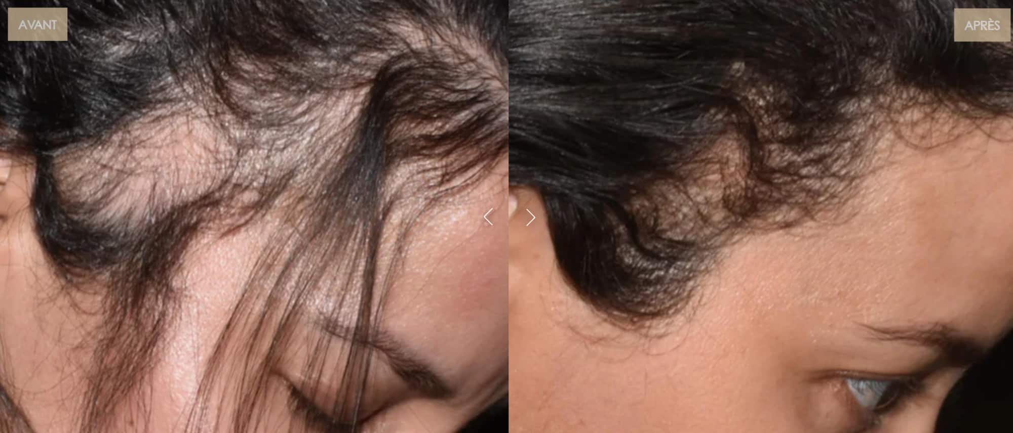 Le casque LED cheveux de Nooance : Mon Avis complet avec test personnel et revue des études 10 avant apres pousse repousse 1