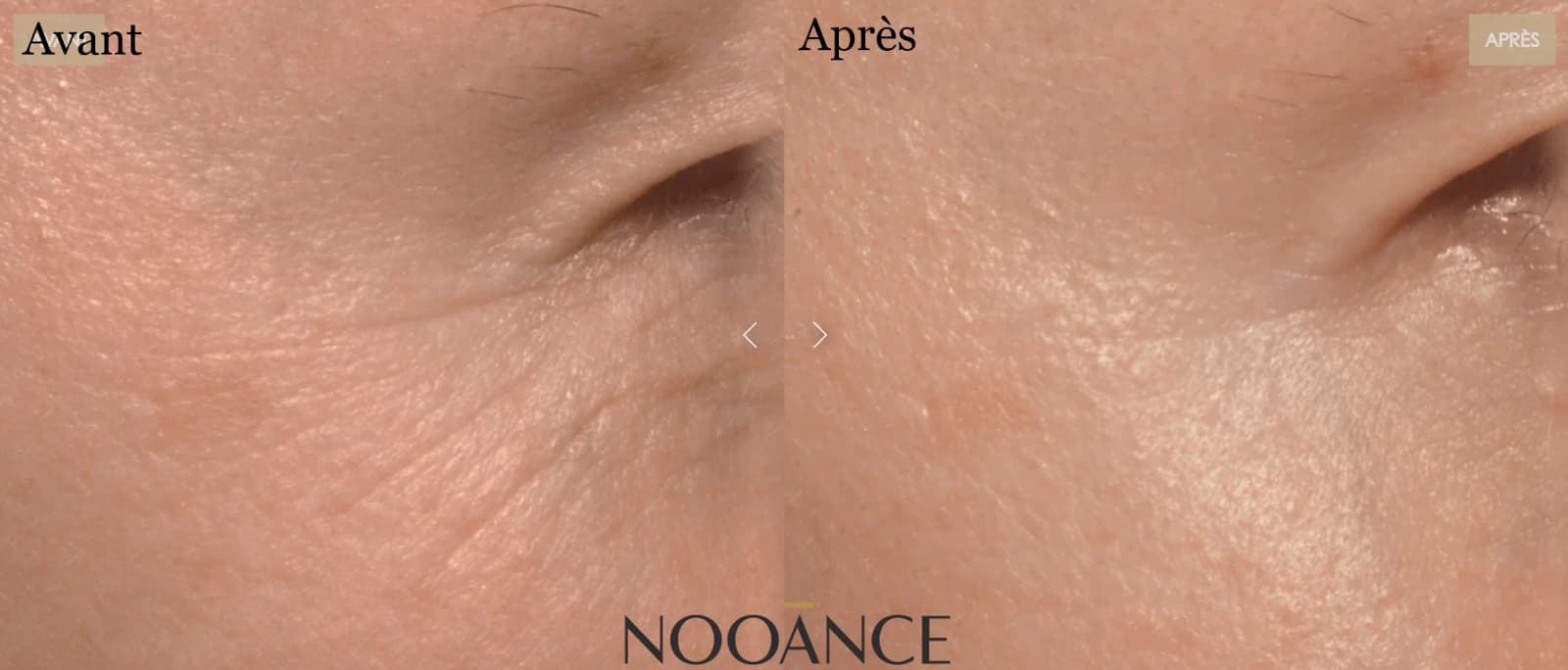 Avis sur Nooance : J'ai testé leur masque à led et je donne mon avis personnel 8 avant apres rides pattes oie nooance 1