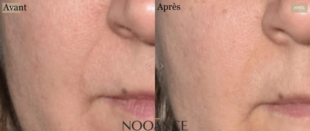 Est-ce que les masques LED sont vraiment efficaces ? Revue des études et des dangers 7 avant apres rides sillon nasogenien nooance 1