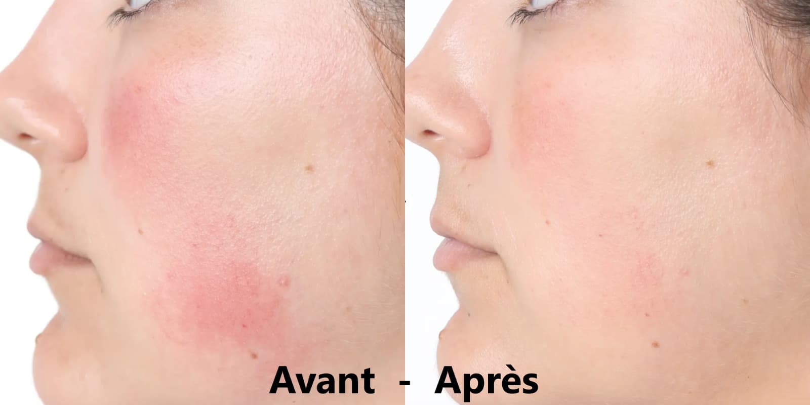 Mon avis sur le masque Silk'n Analyse complète avec résultats et comparatif 8 avant apres rougeur visage silkn 1