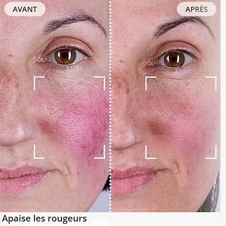 Les avant après des meilleurs masques à LED pour visage : lequel est le plus convaincant ? 12 imgi 15 avant apres rougeurs currentbody