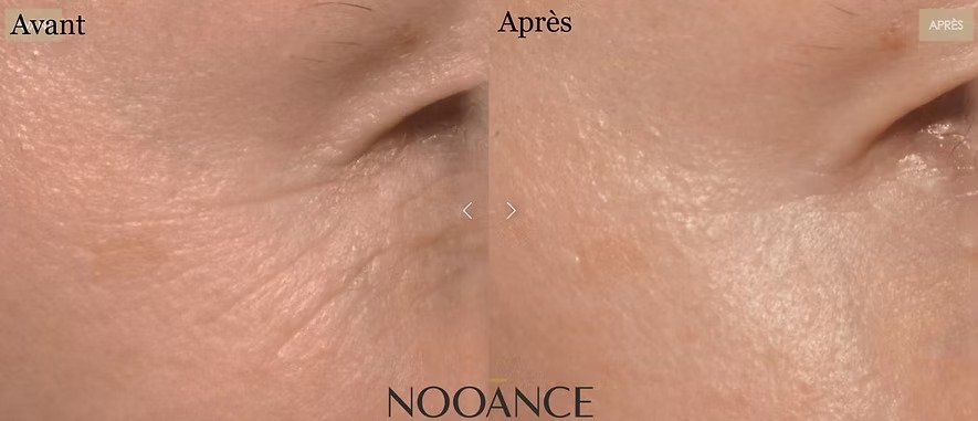 Nooance ou Silk'n : quel masque LED visage choisir (et lequel éviter) ? 13 imgi 20 avant apres rides pattes oie nooance
