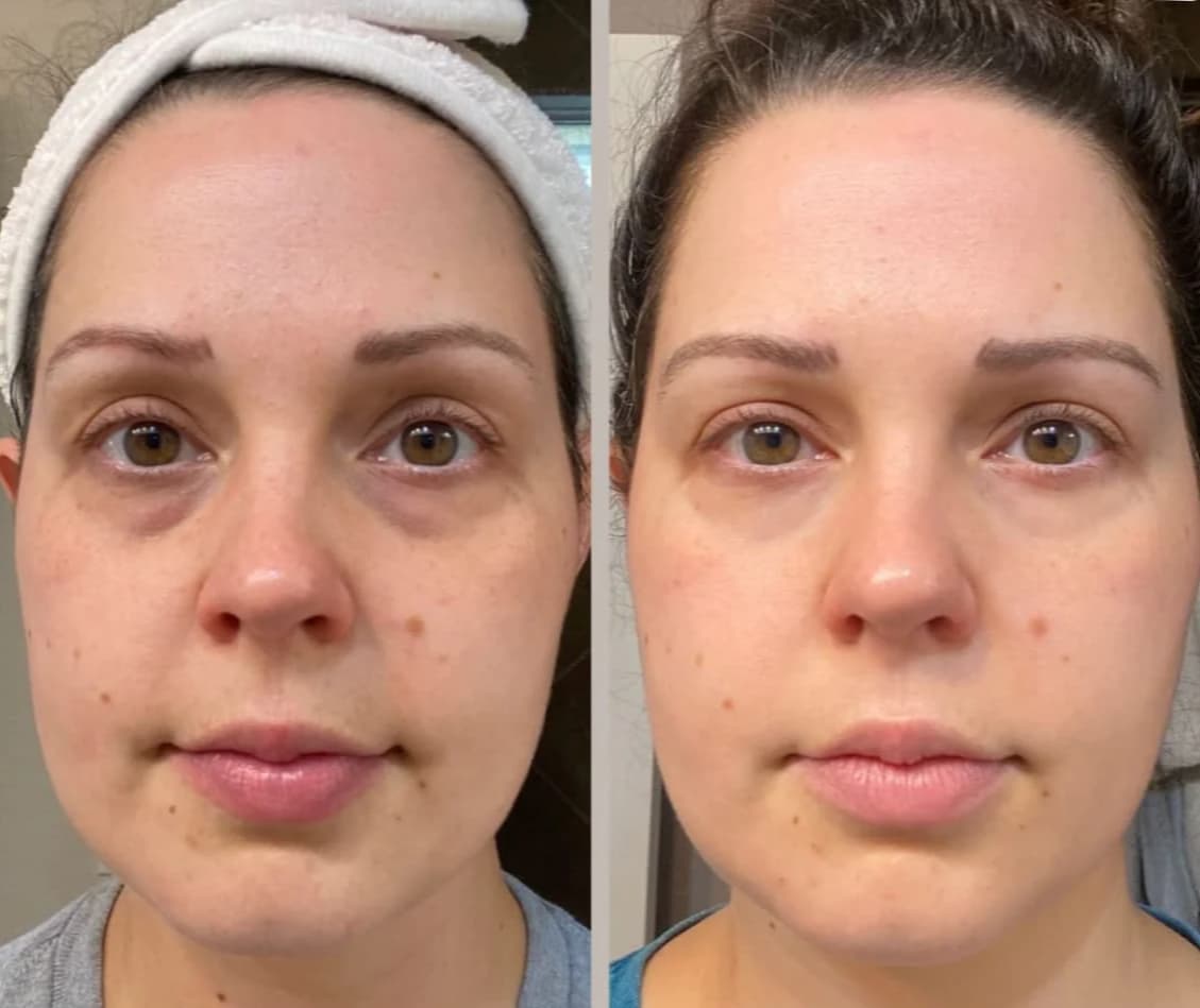 Mon avis sur Nuvaskin : Test avec analyse du stylo et sérum anti-cernes 11 nuvaskin avant apres troisieme