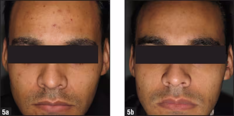 Masque LED anti-acné : est-ce que la lumière bleue fonctionne vraiment ? 4 avant apres masque led bleu acne etude