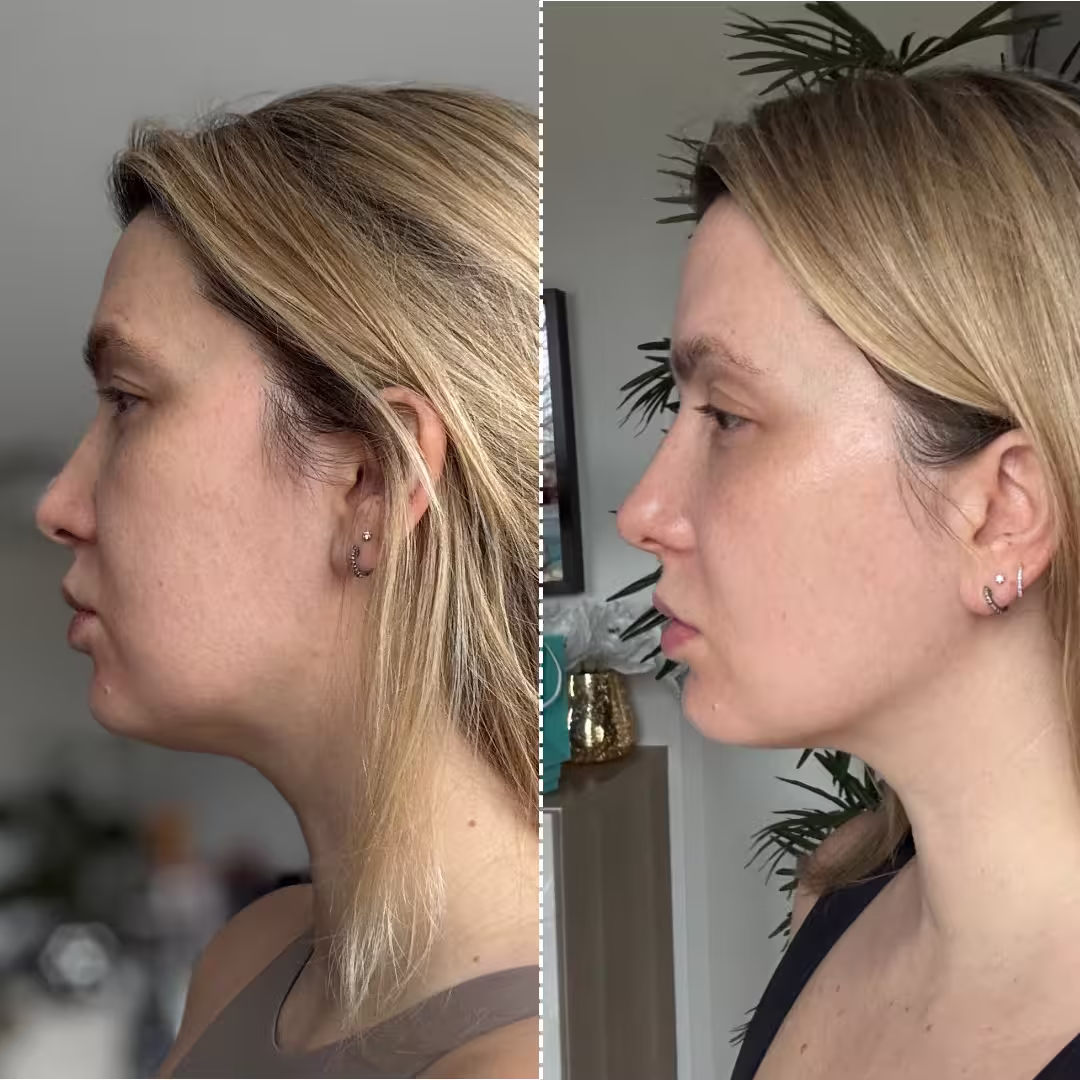 Mon avis sur le Ziip Halo : que vaut l'appareil de microcourants ? 7 deuxieme avant apres ziip beauty avis