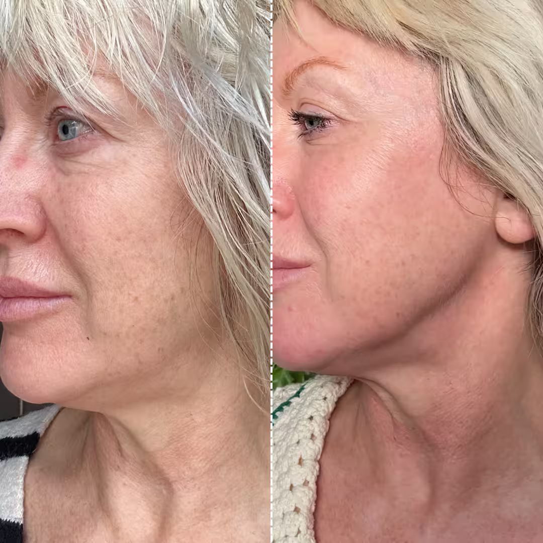 Mon avis sur le Ziip Halo : que vaut l'appareil de microcourants ? 6 premier avant apres ziip beauty