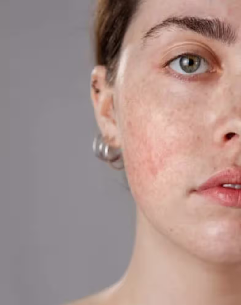 Rosacée : comprendre les rougeurs, les apaiser et trouver ce qui fonctionne vraiment 5 rosacee peau visage rougeurs