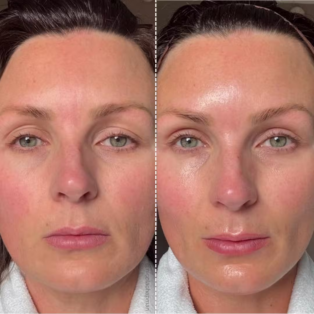 Mon avis sur le Ziip Halo : que vaut l'appareil de microcourants ? 8 troisieme avant apres ziip beauty avis