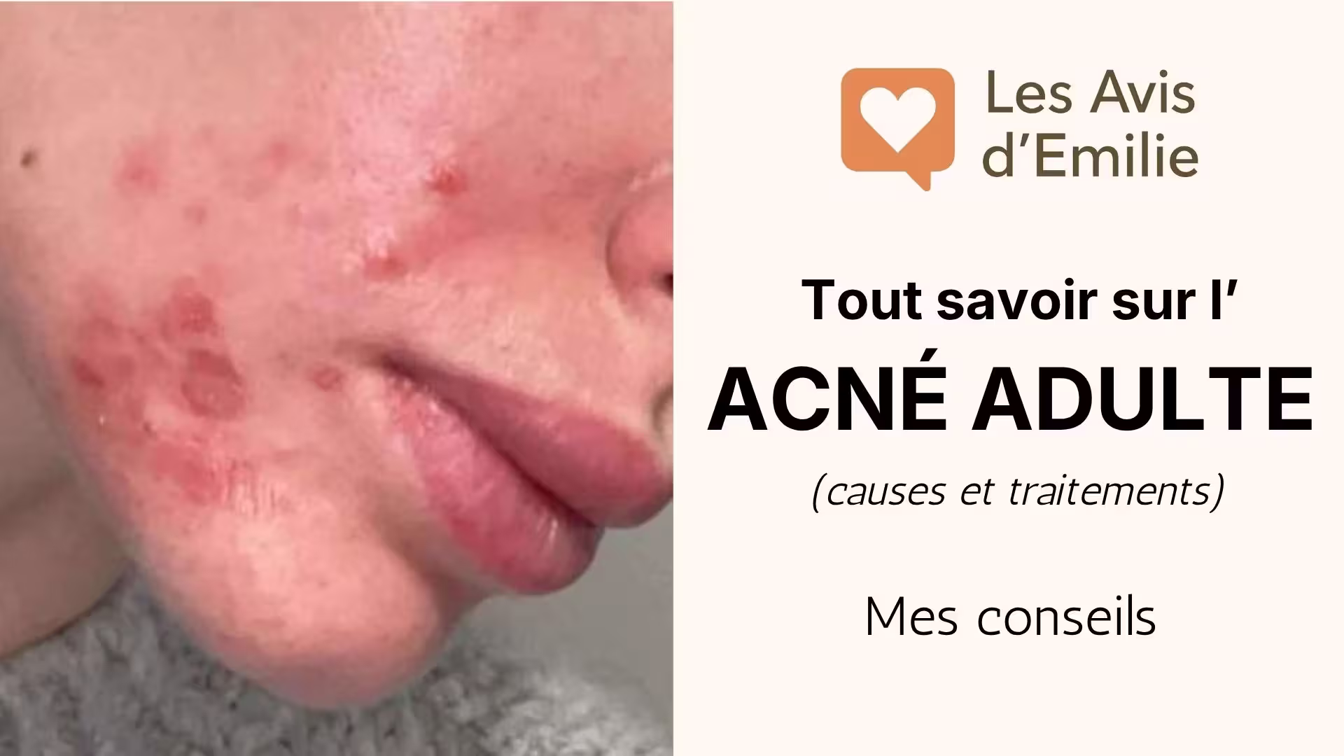Acné adulte chez la femme : causes, routine et traitements naturels efficaces 1 acne femme adulte traitement et causes lesavisdemilie