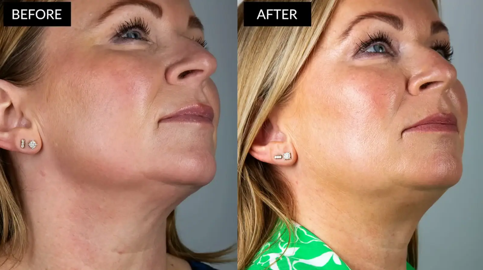 La radiofréquence pour le visage à domicile : est-ce que ça vaut vraiment le coup ? 11 avant apres radiofrequence visage currentbody deuxieme modele