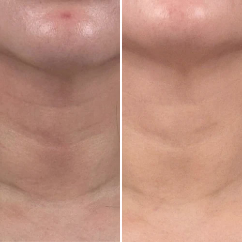 Mon avis sur le masque led cou et décolleté de Currentbody : analyse complète 7 avant apres masque led cou decollete currentbody retour client 1