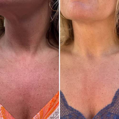 Mon avis sur le masque led cou et décolleté de Currentbody : analyse complète 6 avant apres masque led cou decollete currentbody retour client 2