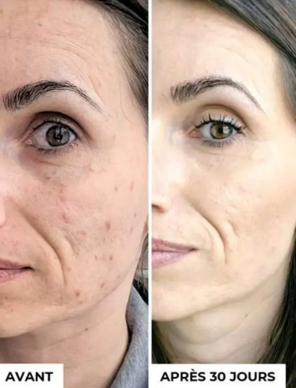 Mon avis sur Laboratoires Dermeden : j'ai testé 4 soins complet 5 avant apres taches brunes dermeden