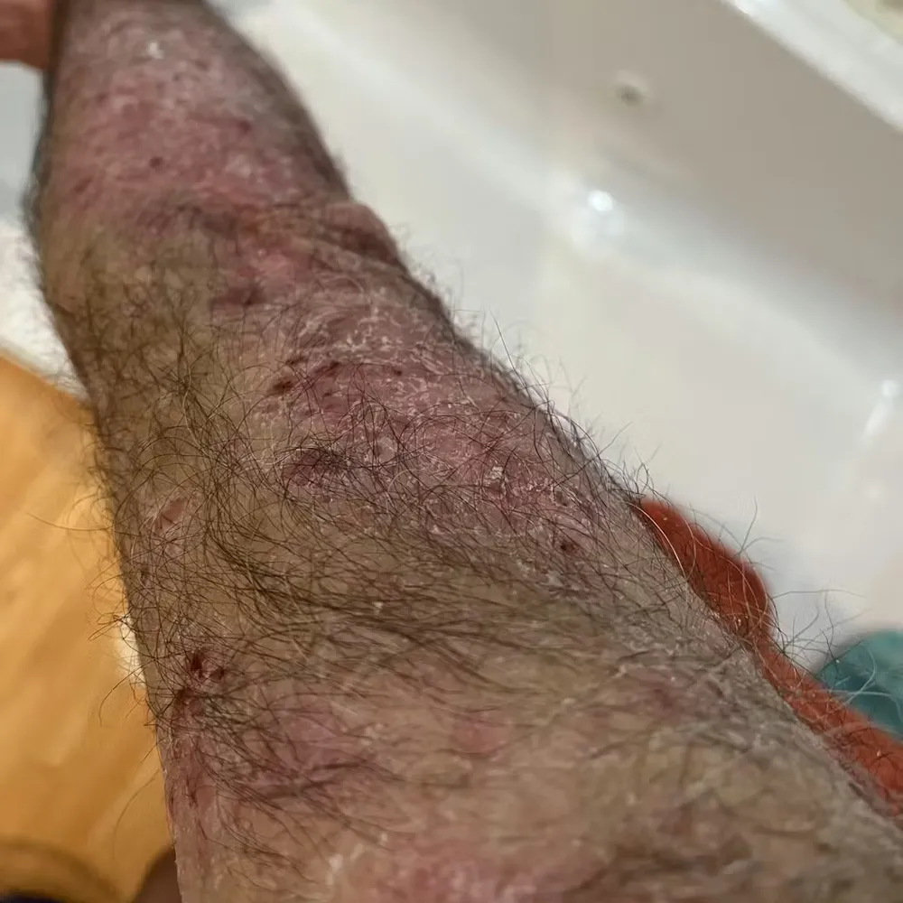 avant psoriasis bras client officine du monde lesavisdemilie