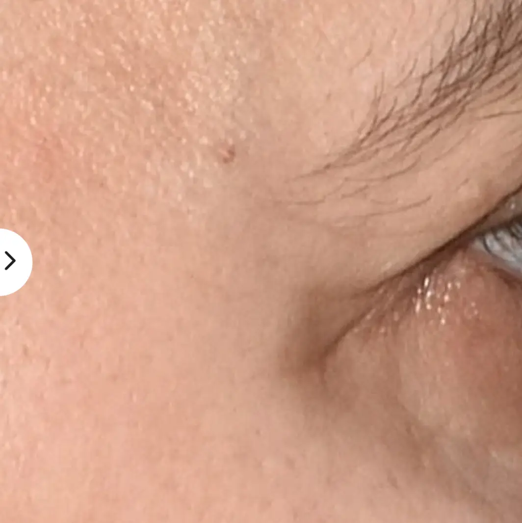 Masque LED MyBlend : Mon avis honnête et mitigé avec analyse complète 10 avant apres photo apres masque led myblend