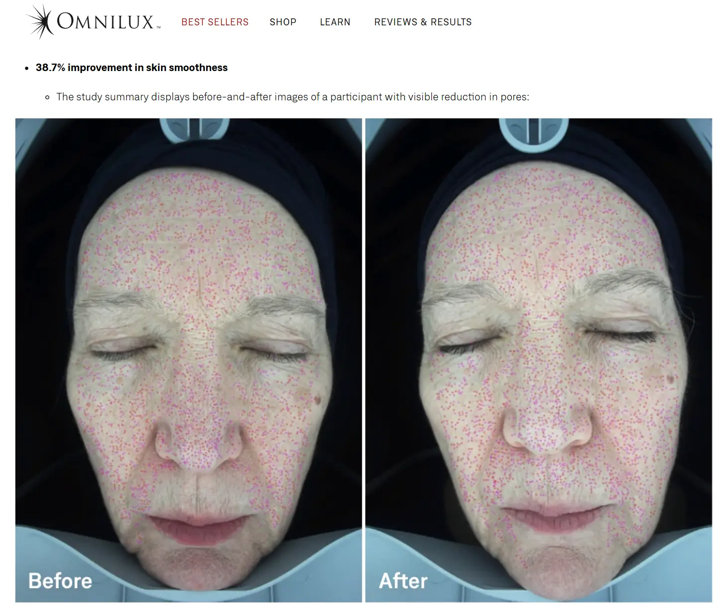 J'ai testé et analysé le masque LED Omnilux : mon avis honnête 9 resultats omnilux etude masque led