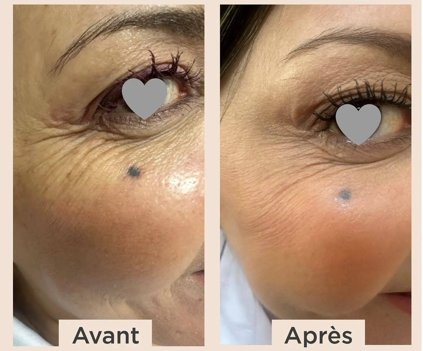 Le PDRN : c'est quoi ? Je teste des soins au PDRN pour évaluer (avec notes Yuka) 2 exemple avant apres pdrn institut clinique