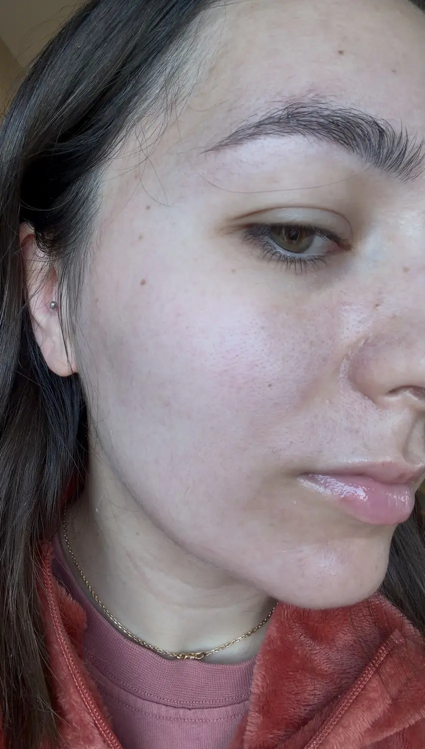 J'ai testé Skin&Out avec 2 mois de bento contre mon acné : avis et photos avant/après 3 avant apres cure skin and out photo apres resultats joue
