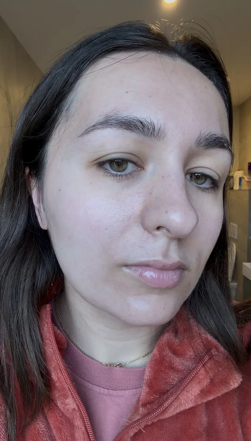 J'ai testé Skin&Out avec 2 mois de bento contre mon acné : avis et photos avant/après 4 avant apres cure skin and out photo apres resultats tout visage
