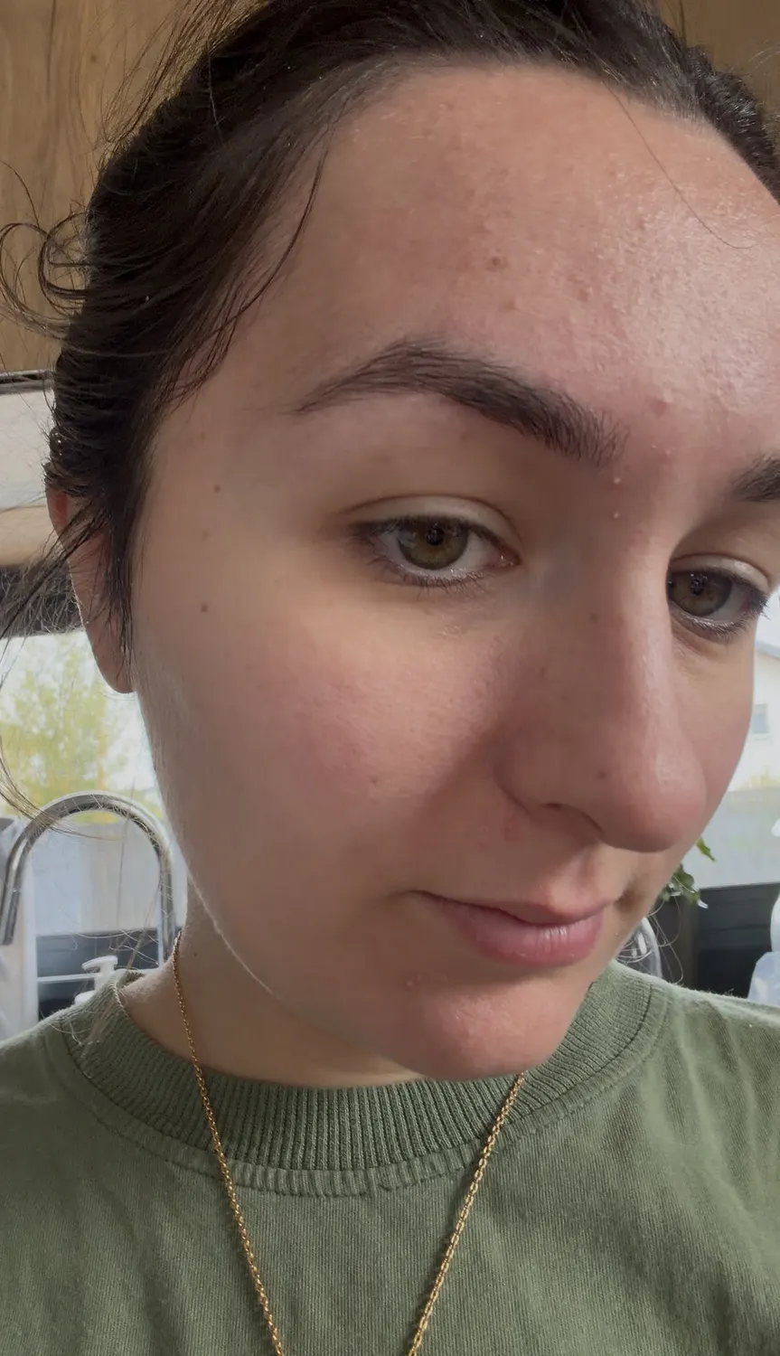 J'ai testé Skin&Out avec 2 mois de bento contre mon acné : avis et photos avant/après 2 avant apres cure skin and out photo avant acne front