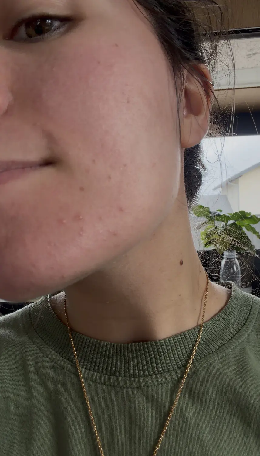 J'ai testé Skin&Out avec 2 mois de bento contre mon acné : avis et photos avant/après 1 avant apres cure skin and out photo avant acne menton